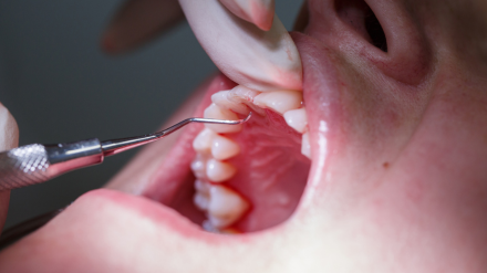 プロによるクリーニング・処置