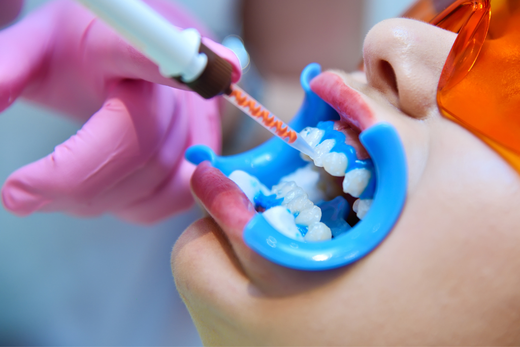 当院のホワイトニング